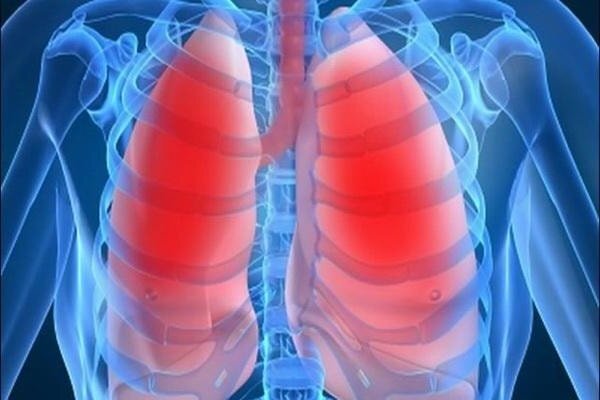Пневмония: причины, симптомы и народные методы лечения